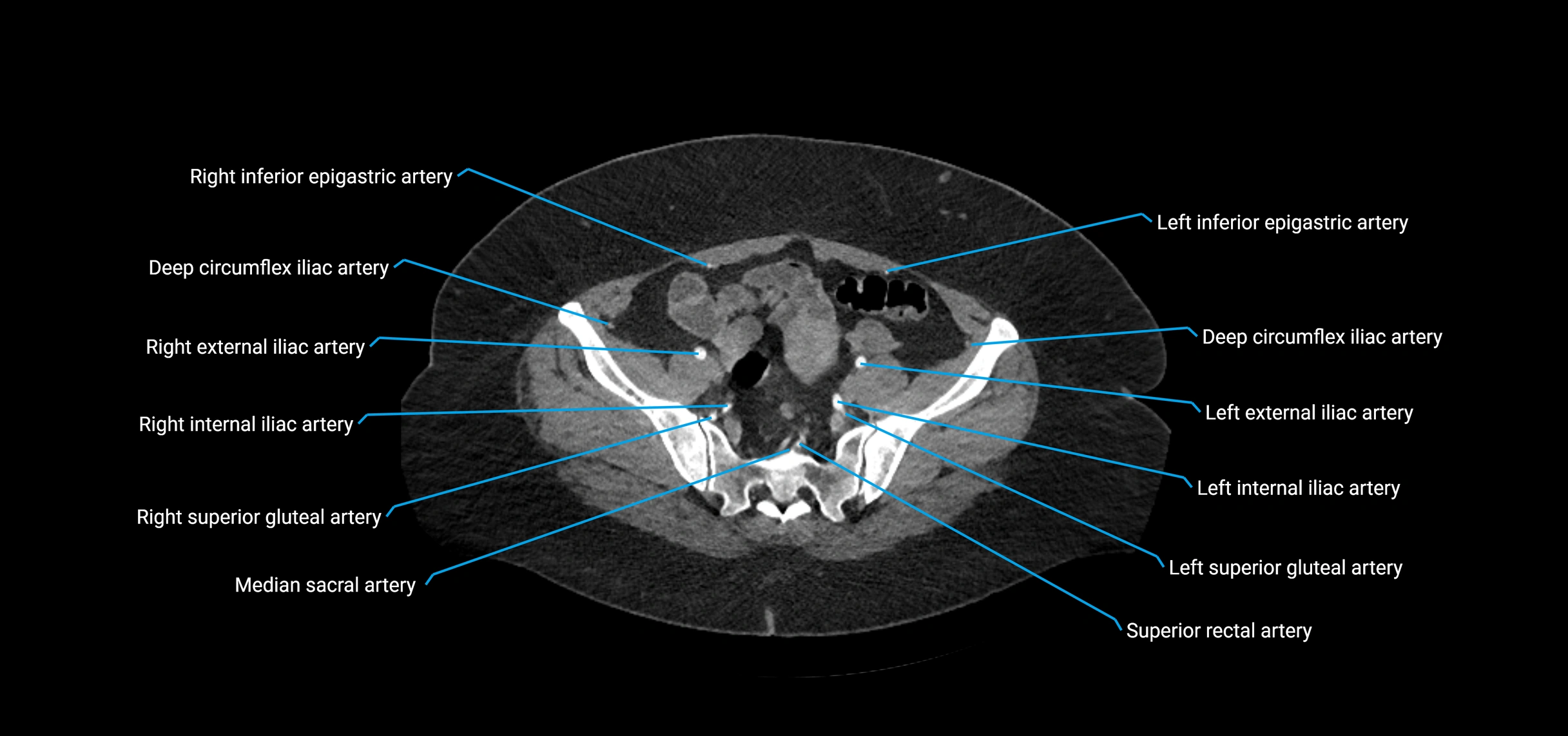 CTA abdomen axial cross sectional anatomy labelled image_200 (2).webp